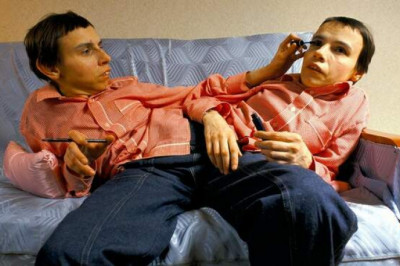 Даша и Маша Кривошляповы: как жили и страдали самые известные сиамские близнецы СССР